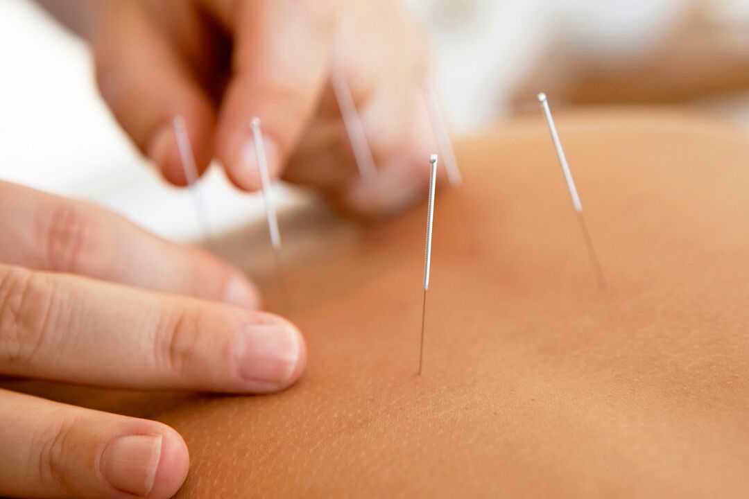 akupunktura za povećanje potencije